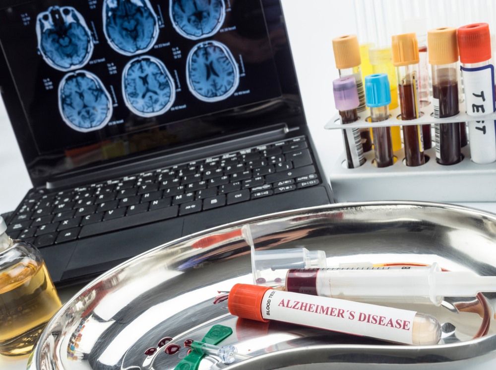 Cognitive Tests for Alzheimer's and Dementia